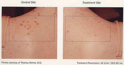 Acne Treatments | BLU-U Therapy for Acne | Upland | Rancho Cucamonga