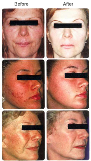 Cosmetic Spa | Facials | Microdermabrasion | B-LIFTx® | Vitalize Peel® | Upland | Rancho Cucamonga