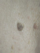 Skin Cancer Screening | Seborrheic Keratoses Treatments | Upland | Rancho Cucamonga
