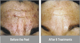 Cosmetic Spa | Facials | Microdermabrasion | B-LIFTx® | Vitalize Peel® | Upland | Rancho Cucamonga